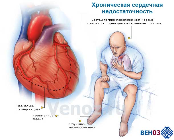 Болезнь сердца сердечная недостаточность. Симптомы острой и хронической сердечной недостаточности. Острая хроническая недостаточность сердца. Острая и хроническая сердечная недостаточность симптомы. ХСН хроническая сердечная недостаточность симптомы.